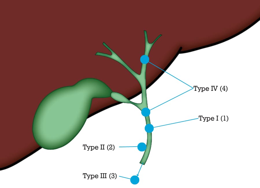 Choledochal cyst illustration